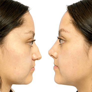 Antes y después: Face lifting