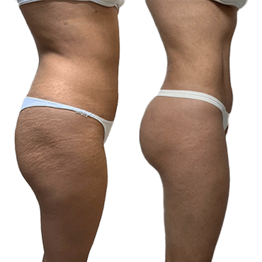 Antes y después: Lipoescultura con abdominoplastia