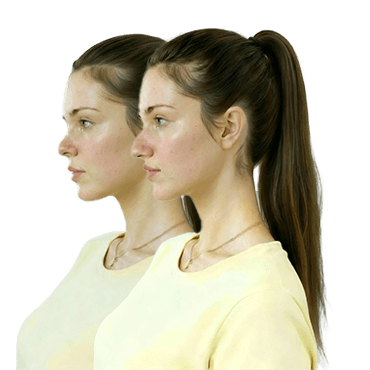 Antes y despúes Papada y Cuello