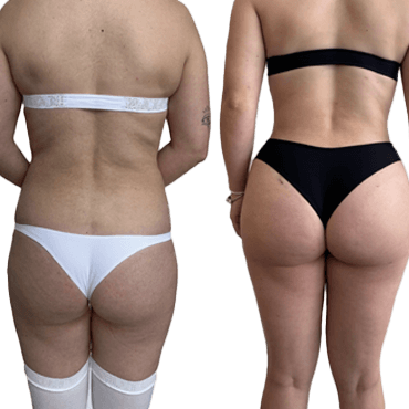 Antes y después Lipoescultura y glúteos