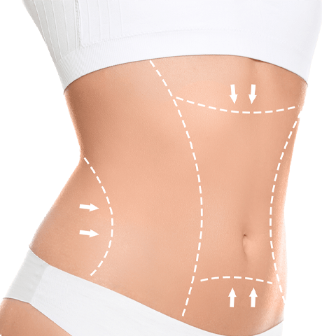 Procedimientos quirúrgicos: Abdominoplastía
