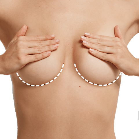 Procedimientos quirúrgicos: Aumento de busto