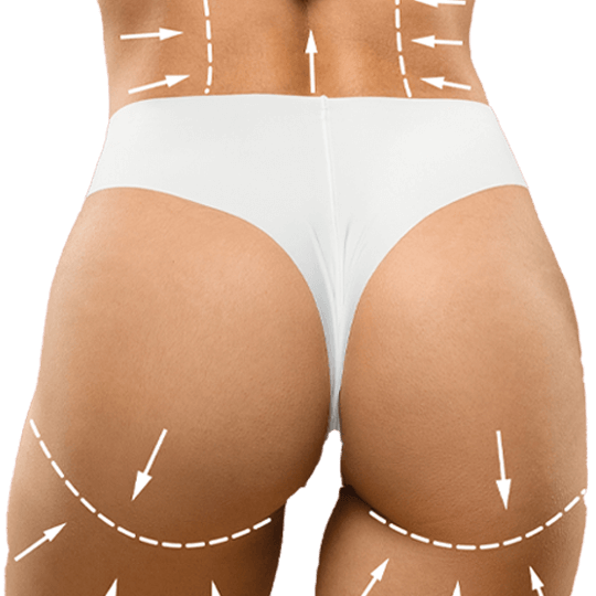 Procedimientos quirúrgicos: BBL