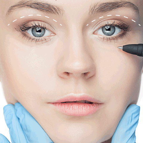 Procedimientos quirúrgicos: Cirugía de Párpados