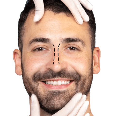 Procedimientos quirúrgicos: Rinoplastía